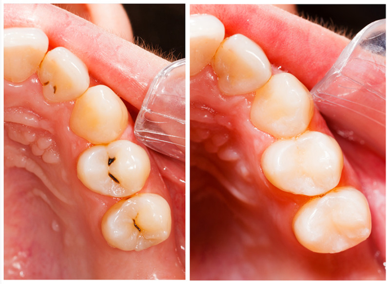 Fillings  Ferndale, WA