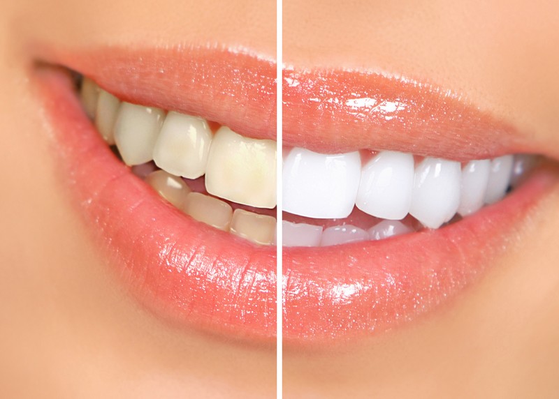 Teeth Whitening  Ferndale, WA